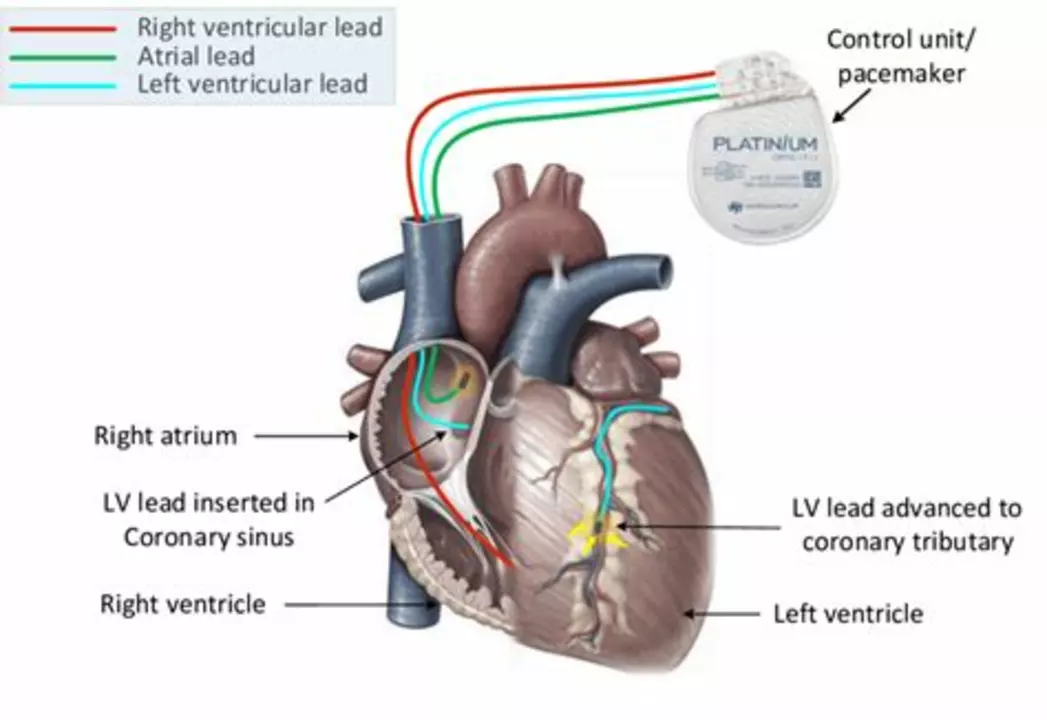 The Importance of Patient Education in Managing Left Ventricular Dysfunction