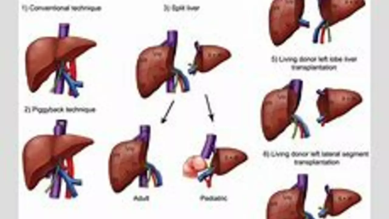 Hepatic Encephalopathy: The Role of Liver Transplantation in Treatment