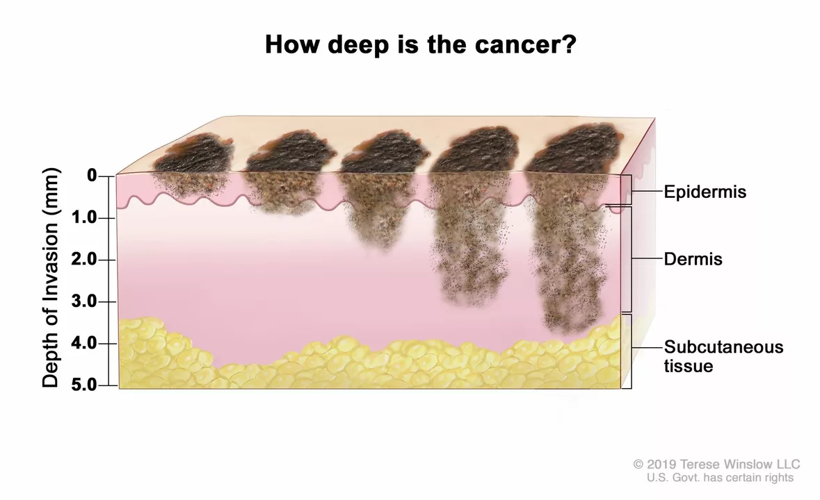 The Connection between Melanoma and Other Cancers